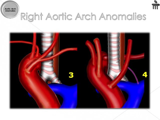 what are aortic arch abnormalities