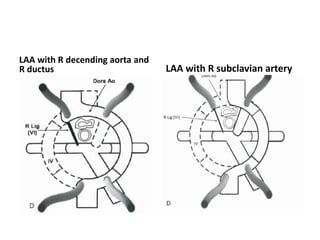 LAA with R decending aorta and
R ductus LAA with R subclavian artery
 