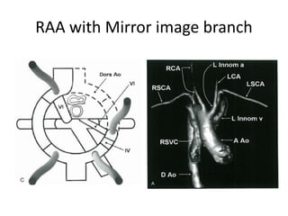 RAA with Mirror image branch
 