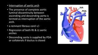 AORTIC ARCH ANOMALIES 2.pptx