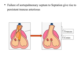 • Failure of aortopulmonary septum to Septation give rise to
persistent truncus arteriosus
 