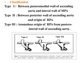 • . Classification
Type I : Between posteromedial wall of ascending
aorta and lateral wall of MPA
Type II : Between posterior wall of ascending aorta
and origin of RPA
Type III : Anomalous origin of RPA from postero-
lateral wall of ascending aorta
 
