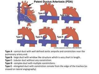 Type A - conical duct with well defined aortic ampulla and constriction near the
pulmonary artery end.
Type B - large duct with window like structure which is very short in length.
Type C - tubular duct without any constriction.
Type D - complex duct with multiple constrictions.
Type E - elongated duct with constriction remote from the edge of the trachea (as
viewed on lateral angiography)
 
