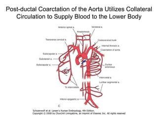 Post-ductal Coarctation of the Aorta Utilizes Collateral
Circulation to Supply Blood to the Lower Body
 