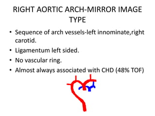 RIGHT AORTIC ARCH-MIRROR IMAGE
TYPE
• Sequence of arch vessels-left innominate,right
carotid.
• Ligamentum left sided.
• No vascular ring.
• Almost always associated with CHD (48% TOF)
 