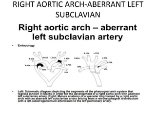 RIGHT AORTIC ARCH-ABERRANT LEFT
SUBCLAVIAN
 