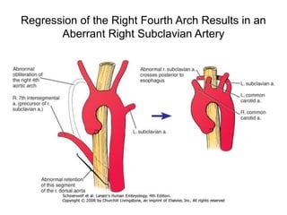 Regression of the Right Fourth Arch Results in an
Aberrant Right Subclavian Artery
 