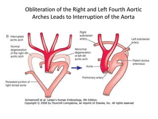 Obliteration of the Right and Left Fourth Aortic
Arches Leads to Interruption of the Aorta
 