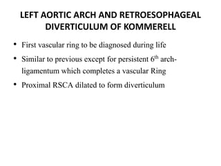 LEFT AORTIC ARCH AND RETROESOPHAGEAL
DIVERTICULUM OF KOMMERELL
• First vascular ring to be diagnosed during life
• Similar to previous except for persistent 6th arch-
ligamentum which completes a vascular Ring
• Proximal RSCA dilated to form diverticulum
 