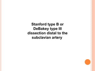 Stanford type B or DeBakey type III dissection distal to the subclavian artery   