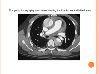 Computed tomography scan demonstrating the true lumen and false lumen   