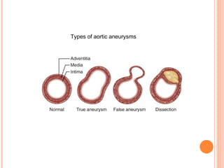 Types of aortic aneurysms   