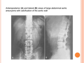 Anteroposterior  ( A )  and lateral  ( B )  views of large abdominal aortic aneurysms with calcification of the aortic wall   