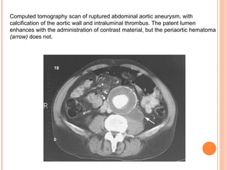 Computed tomography scan of ruptured abdominal aortic aneurysm, with calcification of the aortic wall and intraluminal thrombus. The patent lumen enhances with the administration of contrast material, but the periaortic hematoma   ( arrow )   does not . 