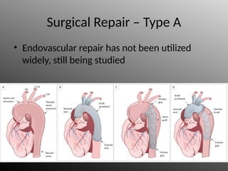 Surgical Repair – Type A
• Endovascular repair has not been utilized
widely, still being studied
 