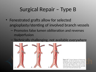 Surgical Repair – Type B
• Fenestrated grafts allow for selected
angioplasty/stenting of involved branch vessels
– Promotes false lumen obliteration and reverses
malperfusion
– Technically challenging, not available everywhere
 