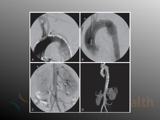 Aortic Dissection and Acute Aortic Syndrome