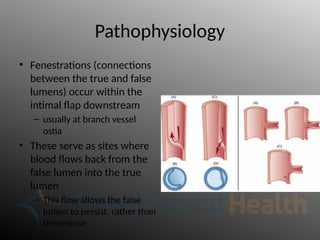Pathophysiology
• Fenestrations (connections
between the true and false
lumens) occur within the
intimal flap downstream
– usually at branch vessel
ostia
• These serve as sites where
blood flows back from the
false lumen into the true
lumen
– This flow allows the false
lumen to persist, rather than
thrombose
 
