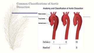 Aortic dissctn | PPTX