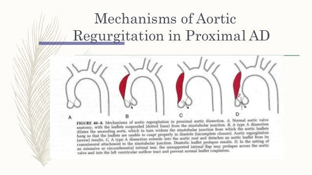 interrupted aortic arch vsd genetic interrupted aortic arch vsd genetic