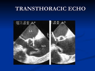 TRANSTHORACIC ECHO 
