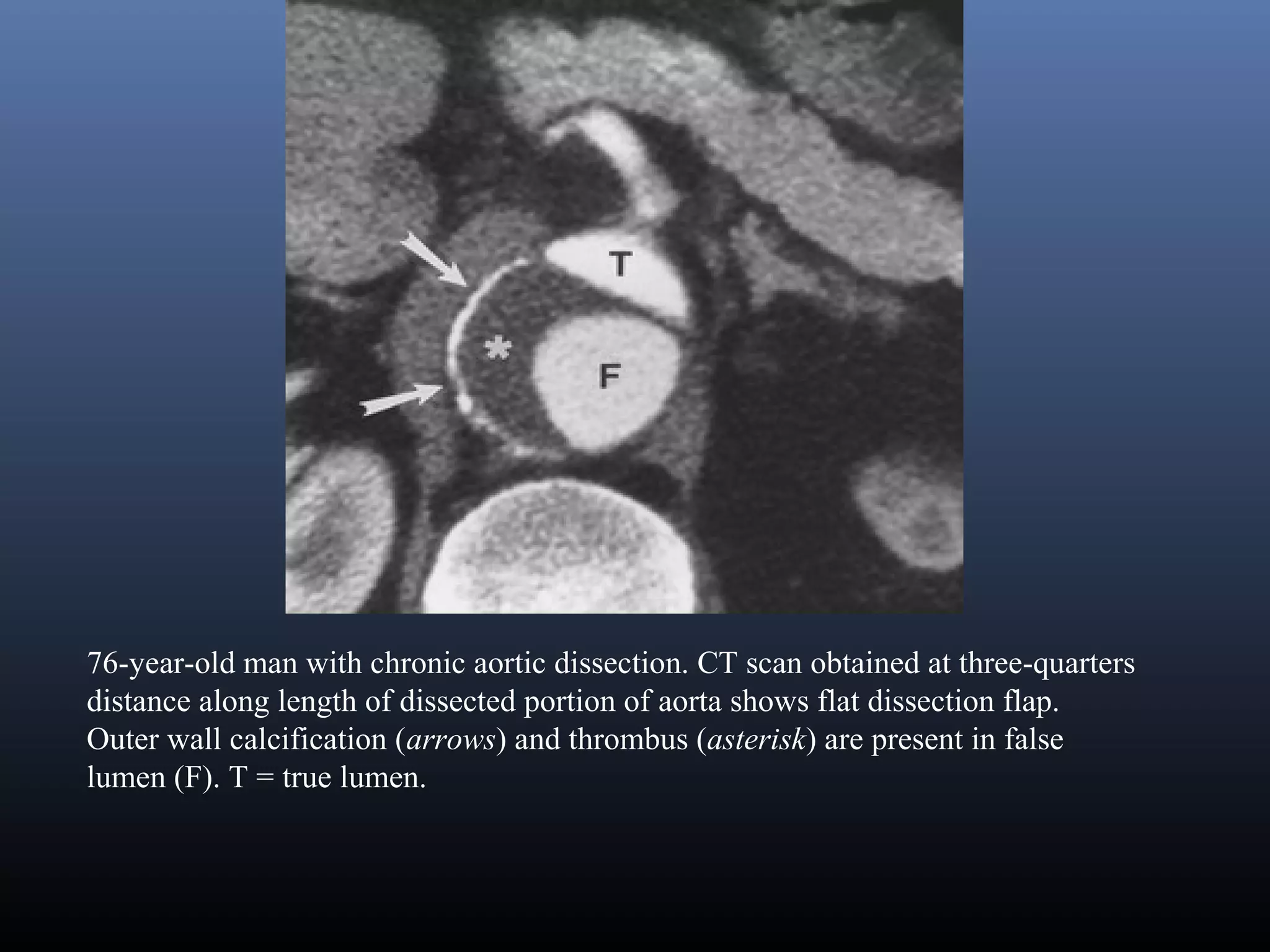 Imaging of Aortic Dissection | PPT