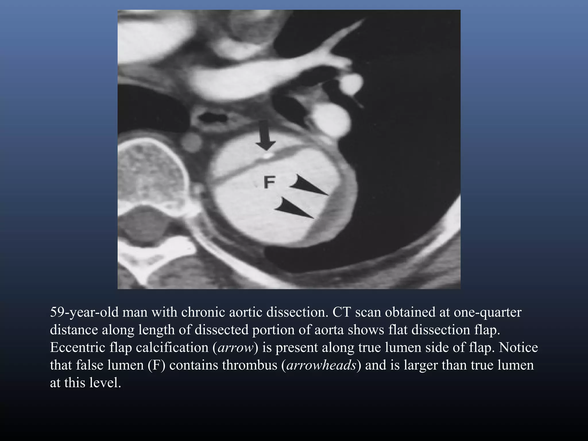 Imaging of Aortic Dissection | PPT