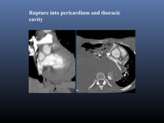 Imaging of Aortic Dissection | PPT