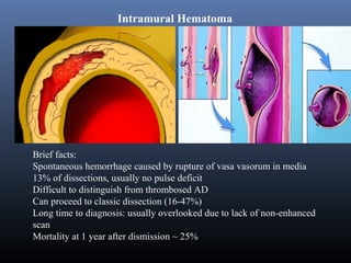 Imaging of Aortic Dissection | PPT