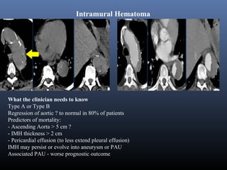 Imaging of Aortic Dissection | PPT