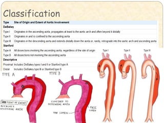 Aortic dissection | PPTX