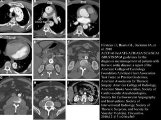 Hiratzka LF, Bakris GL, Beckman JA, et
al. 2010
ACCF/AHA/AATS/ACR/ASA/SCA/SCAI
/SIR/STS/SVM guidelines for the
diagnosis and management of patients with
thoracic aortic disease: a report of the
American College of Cardiology
Foundation/American Heart Association
Task Force on Practice Guidelines,
American Association for Thoracic
Surgery, American College of Radiology,
American Stroke Association, Society of
Cardiovascular Anesthesiologists,
Society for Cardiovascular Angiography
and Interventions, Society of
Interventional Radiology, Society of
Thoracic Surgeons, and Society for
Vascular Medicine. Circulation.
2010;121(13):e266-e369
 