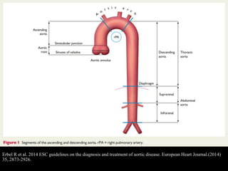 Erbel R et al. 2014 ESC guidelines on the diagnosis and treatment of aortic disease. European Heart Journal.(2014)
35, 2873-2926.
 
