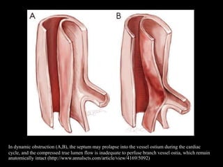 In dynamic obstruction (A,B), the septum may prolapse into the vessel ostium during the cardiac
cycle, and the compressed true lumen flow is inadequate to perfuse branch vessel ostia, which remain
anatomically intact (http://www.annalscts.com/article/view/4169/5092)
 