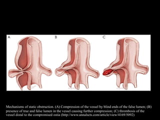 Mechanisms of static obstruction. (A) Compression of the vessel by blind ends of the false lumen; (B)
presence of true and false lumen in the vessel causing further compression; (C) thrombosis of the
vessel distal to the compromised ostia (http://www.annalscts.com/article/view/4169/5092)
 