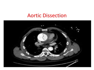 Aortic Dissection
 