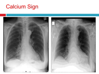 Aortic Dissection X Ray