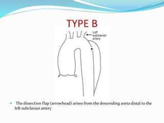 TYPE B
 The dissection flap (arrowhead) arises from the descending aorta distal to the
left subclavian artery
 