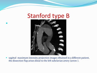 Stanford type B

 sagittal maximum intensity projection images obtained in a different patient,
the dissection flap arises distal to the left subclavian artery (arrow ).
 