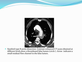 Stanford type B aortic dissection. Contrast-enhanced CT scans obtained at
different levels show a thrombosed false lumen (circle ). Arrow indicates a
small residual flow channel in the false lumen.
 