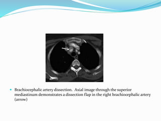  Brachiocephalic artery dissection. Axial image through the superior
mediastinum demonstrates a dissection flap in the right brachiocephalic artery
(arrow)
 