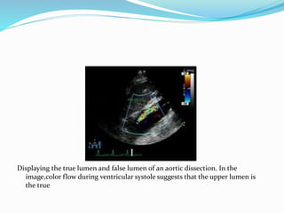 Displaying the true lumen and false lumen of an aortic dissection. In the
image,color flow during ventricular systole suggests that the upper lumen is
the true
 