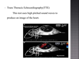 Tte Testing AORTIC DISSECTION | PPTX