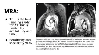 Aortic dissection .pptx