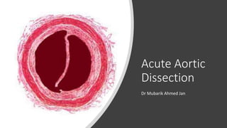 Acute Aortic
Dissection
Dr Mubarik Ahmed Jan
 
