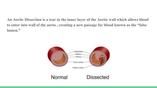An Aortic Dissection is a tear in the inner layer of the Aortic wall which allows blood
to enter into wall of the aorta , creating a new passage for blood known as the “false
lumen.”
 