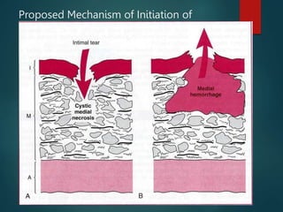 AORTIC DISSECTION and management of aortic dissection | PPTX