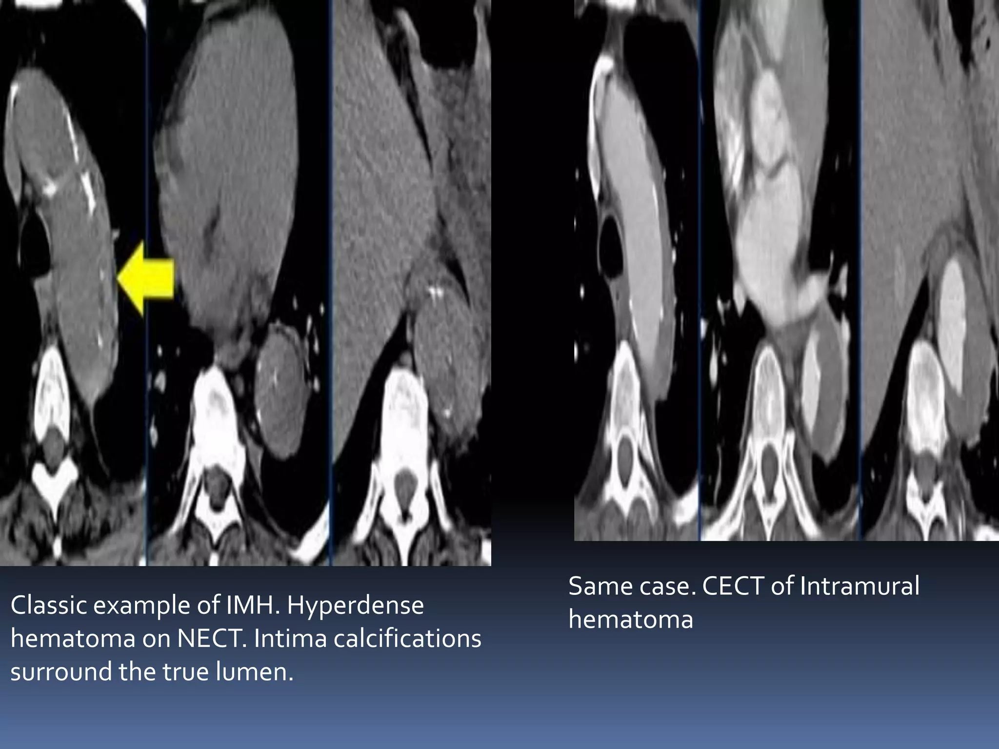 Aortic dissection 01 | PPTX