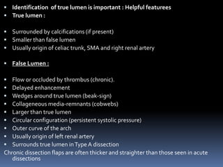 Aortic dissection 01 | PPTX