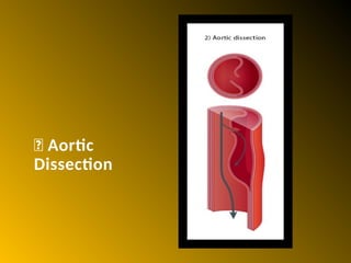 Aortic Dissection, Aortic Syndromes & Aneurysmal Diseases by KEYUR.pptx